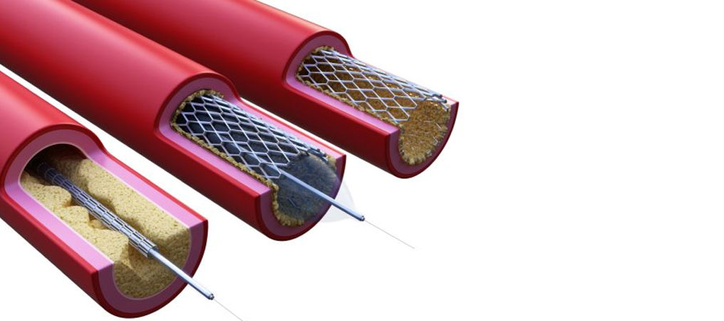 Kardiyovasküler Sağlıkta Stent Kullanımı